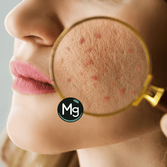 Magnesium For Acne